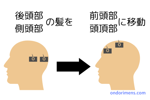 植毛とは