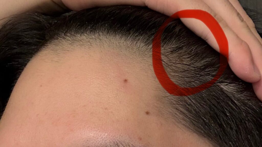 フィナステリド再開1年