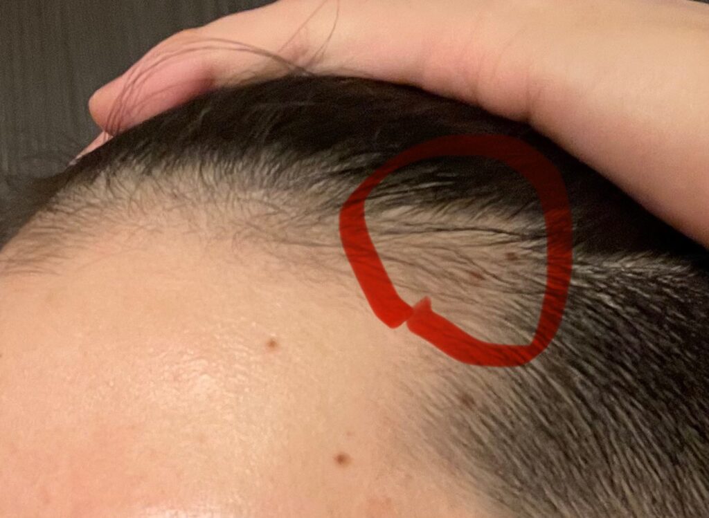 フィナステリド再開前